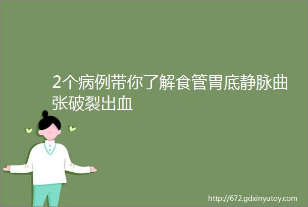 2个病例带你了解食管胃底静脉曲张破裂出血